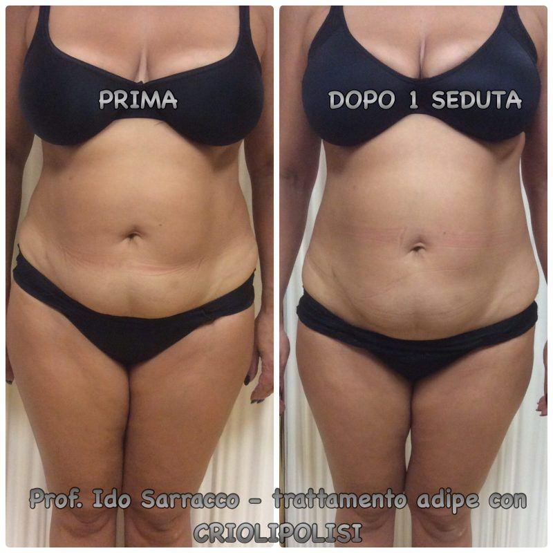Criolipolisi Liposcultura Non Chirurgica Prof Ido Sarracco