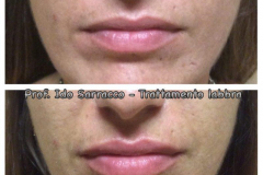 Filler labbra con acido ialuronico 4