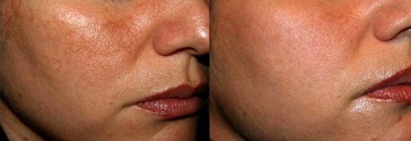 Melasma prima e dopo