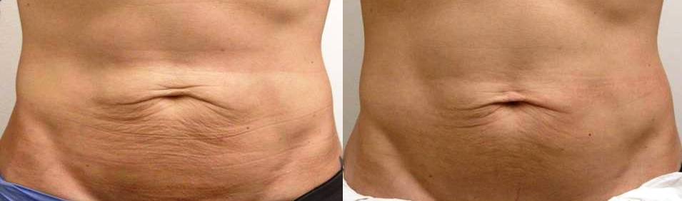 Radiofrequenza Medica Corpo