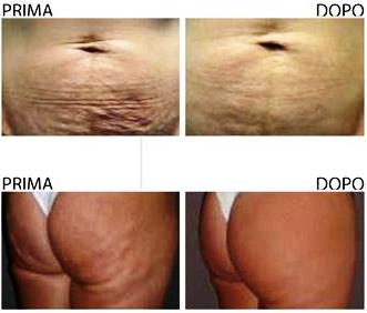 Carbossiterapia, trattamento anti cellulite prima e dopo Carbossiterapia, trattamento anti cellulite prima e dopo