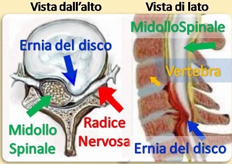 cervicale-cervicalgia-ernia-torcicollo1