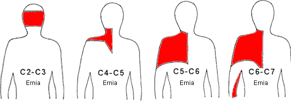 dolore-ernia-cervicale