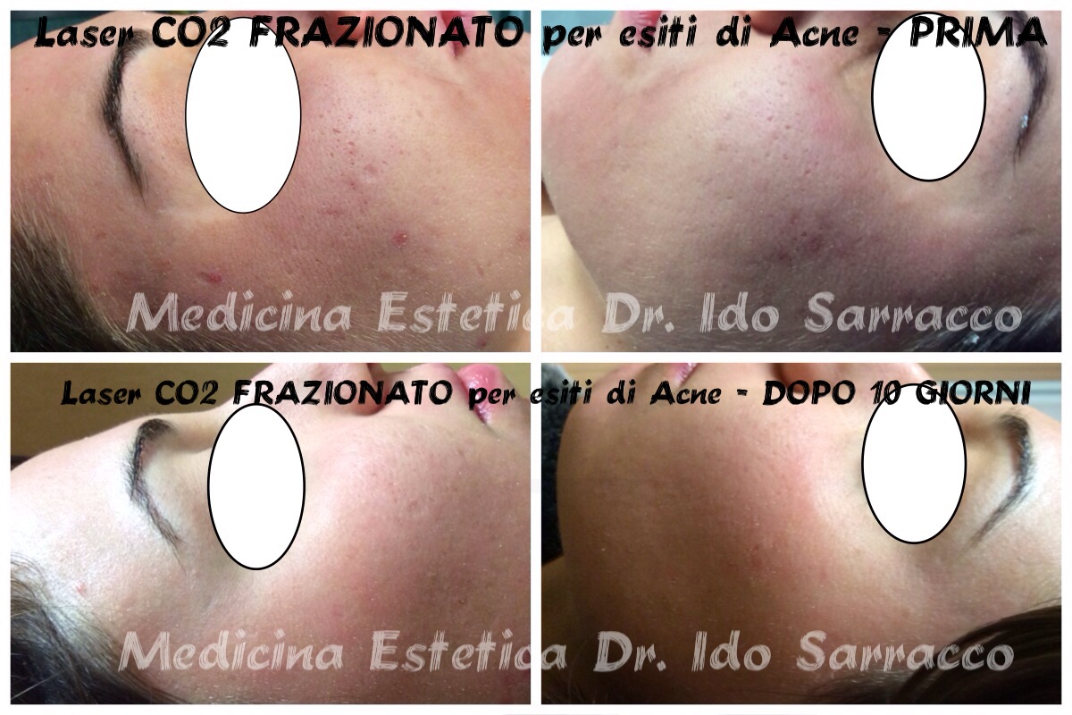 laser viso acne