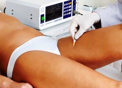 Carbossiterapia anticellulite interno coscia Carbossiterapia anticellulite interno coscia